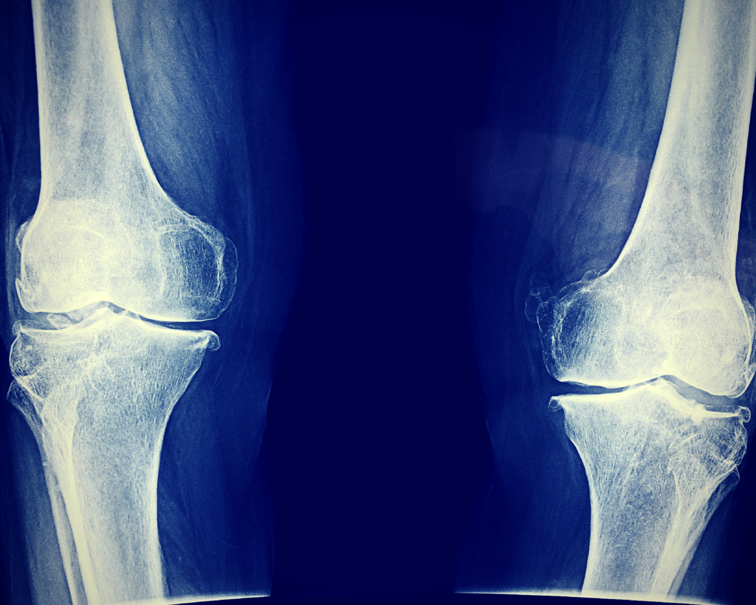 Arthrose du genou: quels sont les traitements ?